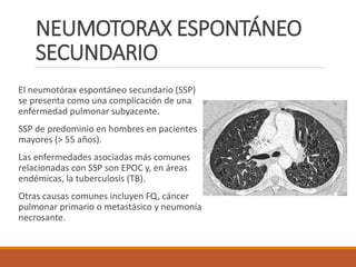 NEUMOTORAX ESPONTÁNEO
SECUNDARIO
El neumotórax espontáneo secundario (SSP)
se presenta como una complicación de una
enfermedad pulmonar subyacente.
SSP de predominio en hombres en pacientes
mayores (> 55 años).
Las enfermedades asociadas más comunes
relacionadas con SSP son EPOC y, en áreas
endémicas, la tuberculosis (TB).
Otras causas comunes incluyen FQ, cáncer
pulmonar primario o metastásico y neumonía
necrosante.
 