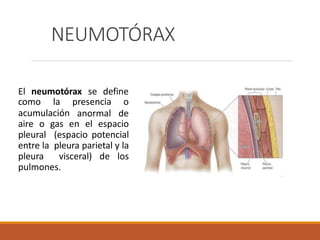 NEUMOTÓRAX
El neumotórax se define
acumulación
como la presencia o
anormal de
aire o gas en el espacio
pleural (espacio potencial
entre la pleura parietal y la
pleura visceral) de los
pulmones.
 