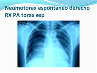 Neumotorax espontaneo derecho
RX PA torax esp
 