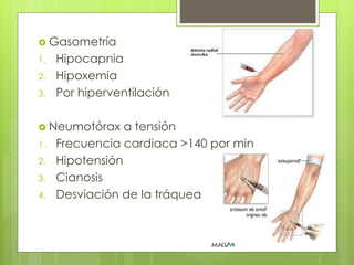  Gasometría
1. Hipocapnia
2. Hipoxemia
3. Por hiperventilación
 Neumotórax a tensión
1. Frecuencia cardiaca >140 por min
2. Hipotensión
3. Cianosis
4. Desviación de la tráquea
 