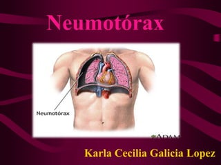Neumotórax
Karla Cecilia Galicia Lopez
 