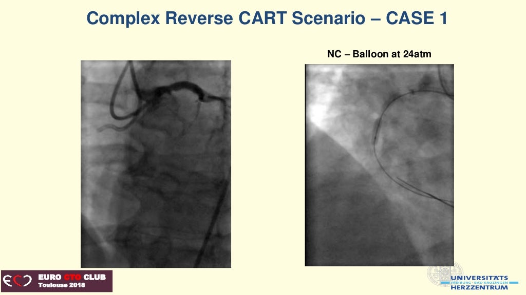 Reverse CART techniques conventional, directed, extended, assisted