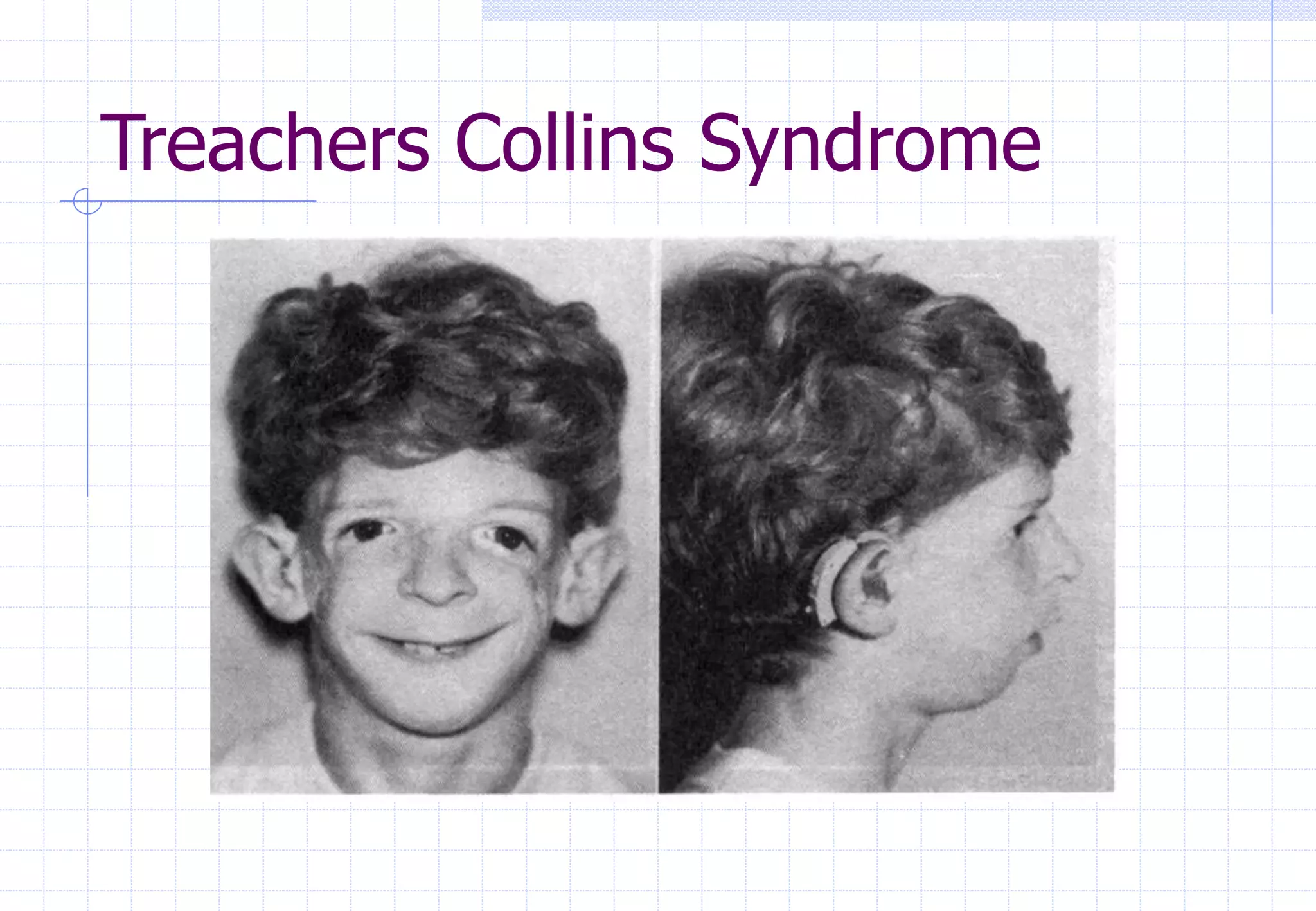 Treachers Collins Syndrome
 
