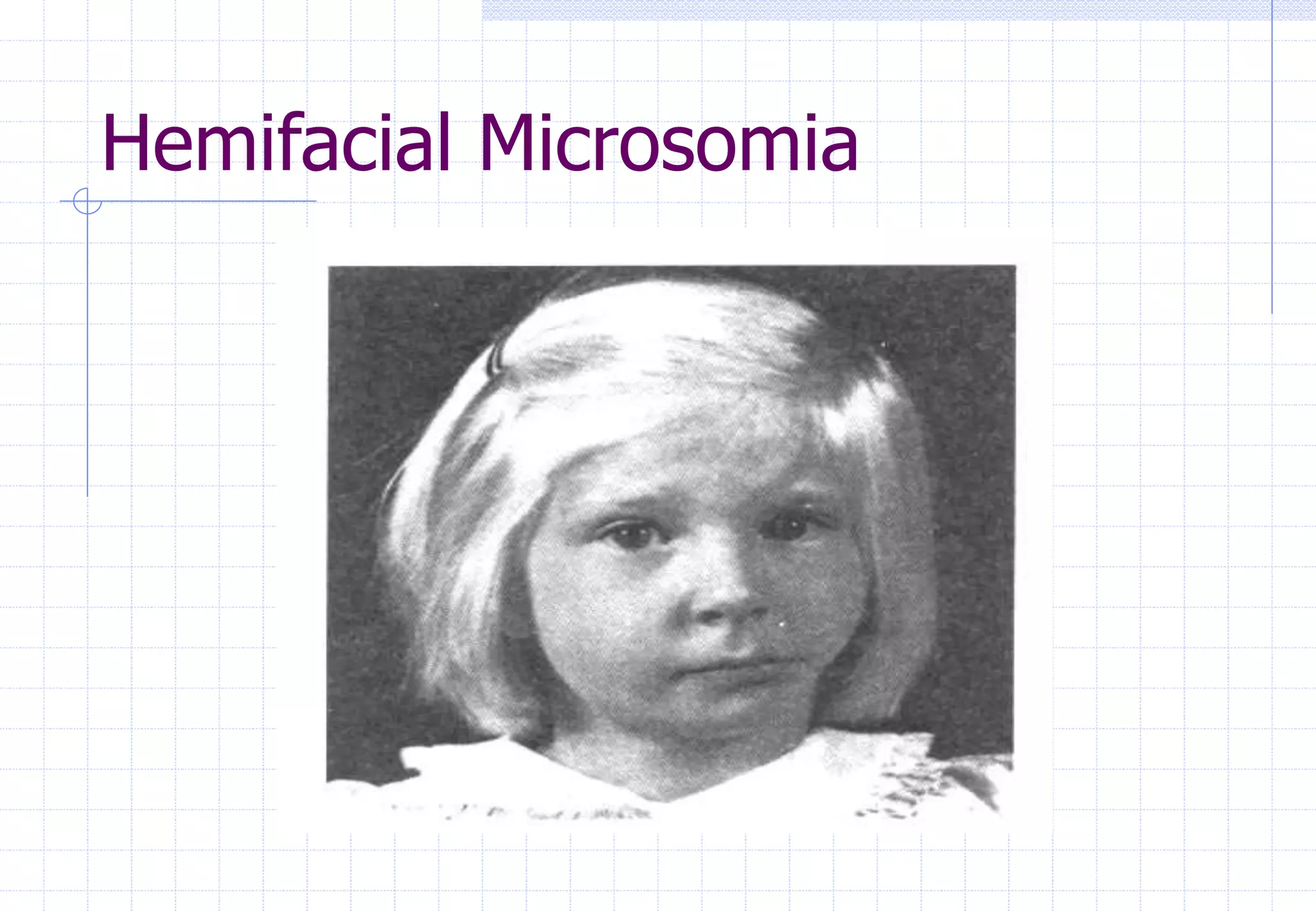 Hemifacial Microsomia
 