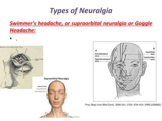 Types of Neuralgia
Swimmer's headache, or supraorbital neuralgia or Goggle
Headache:
• .
Proc (Bayl Univ Med Cent). 2004 Oct; 17(4): 418–419. [PMC1200682]
 