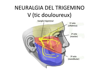 NEURALGIA DEL TRIGEMINO
    V (tic douloureux)
 