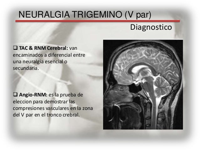 Neuralgia del trigemino