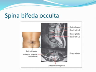 Spina bifeda occulta
 