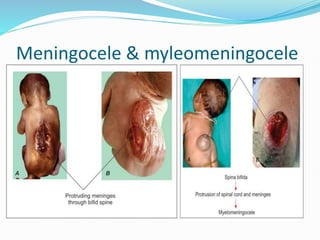 Meningocele & myleomeningocele
 