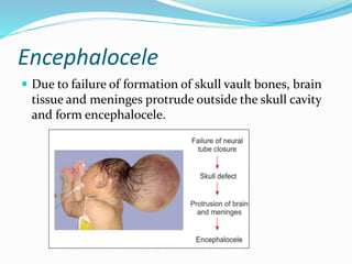 Encephalocele
 Due to failure of formation of skull vault bones, brain
tissue and meninges protrude outside the skull cavity
and form encephalocele.
 