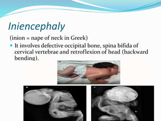 Iniencephaly
(inion = nape of neck in Greek)
 It involves defective occipital bone, spina bifida of
cervical vertebrae and retroflexion of head (backward
bending).
 