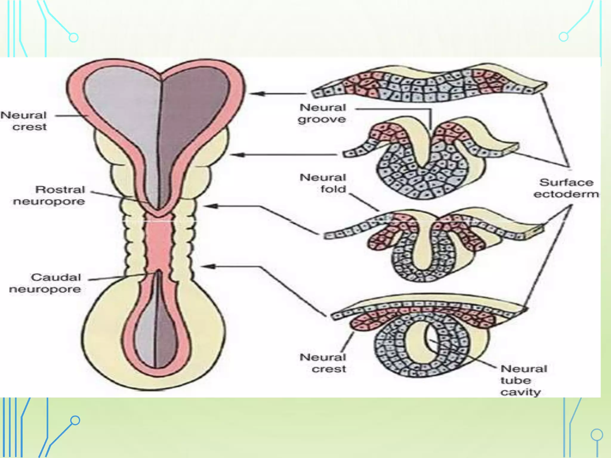 Netural Defect Neural tube defect | PPTX