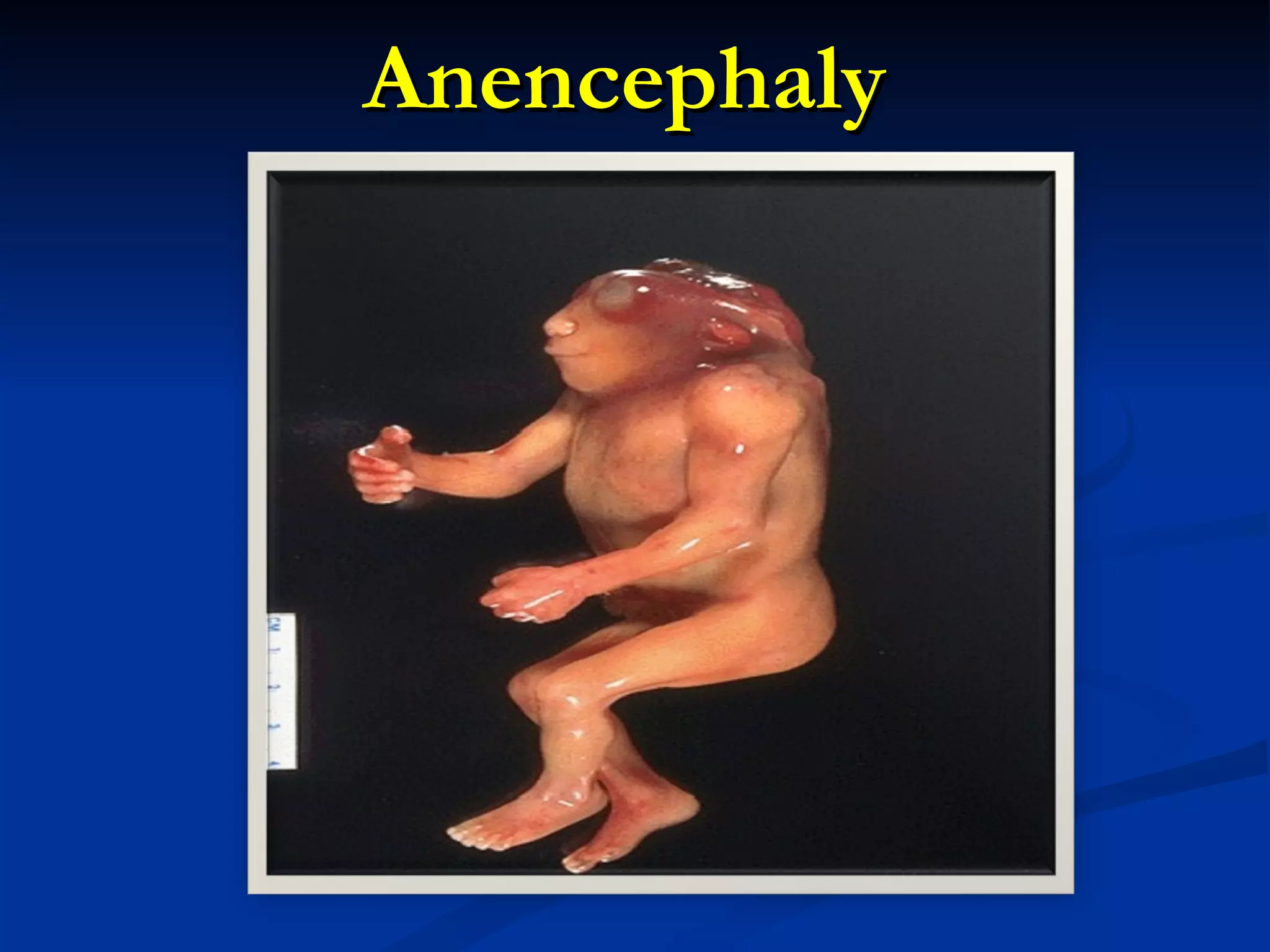 Anencephaly 