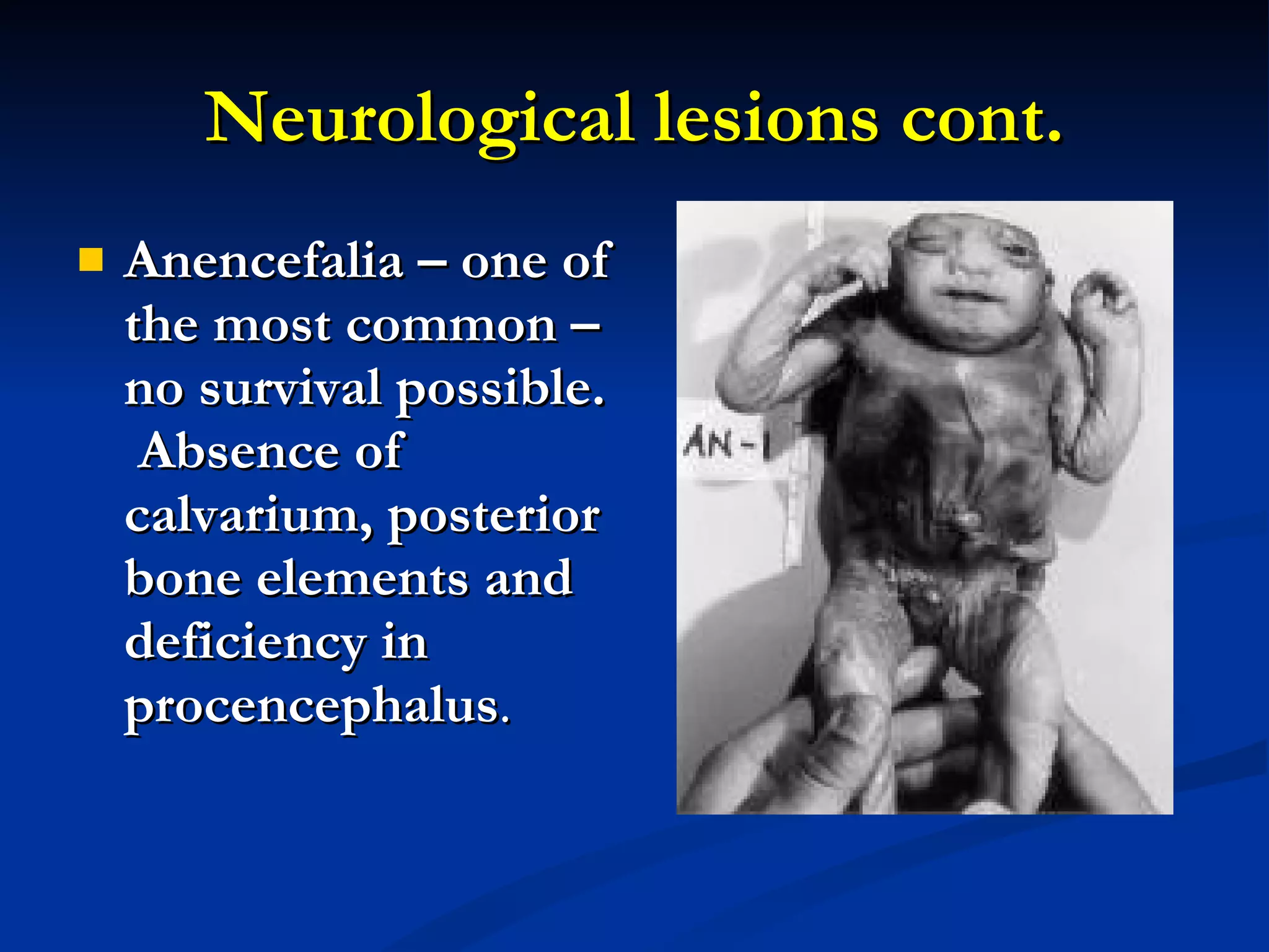 Neurological lesions cont. Anencefalia – one of the most common – no survival possible.  Absence of calvarium, posterior bone elements and deficiency in procencephalus . 