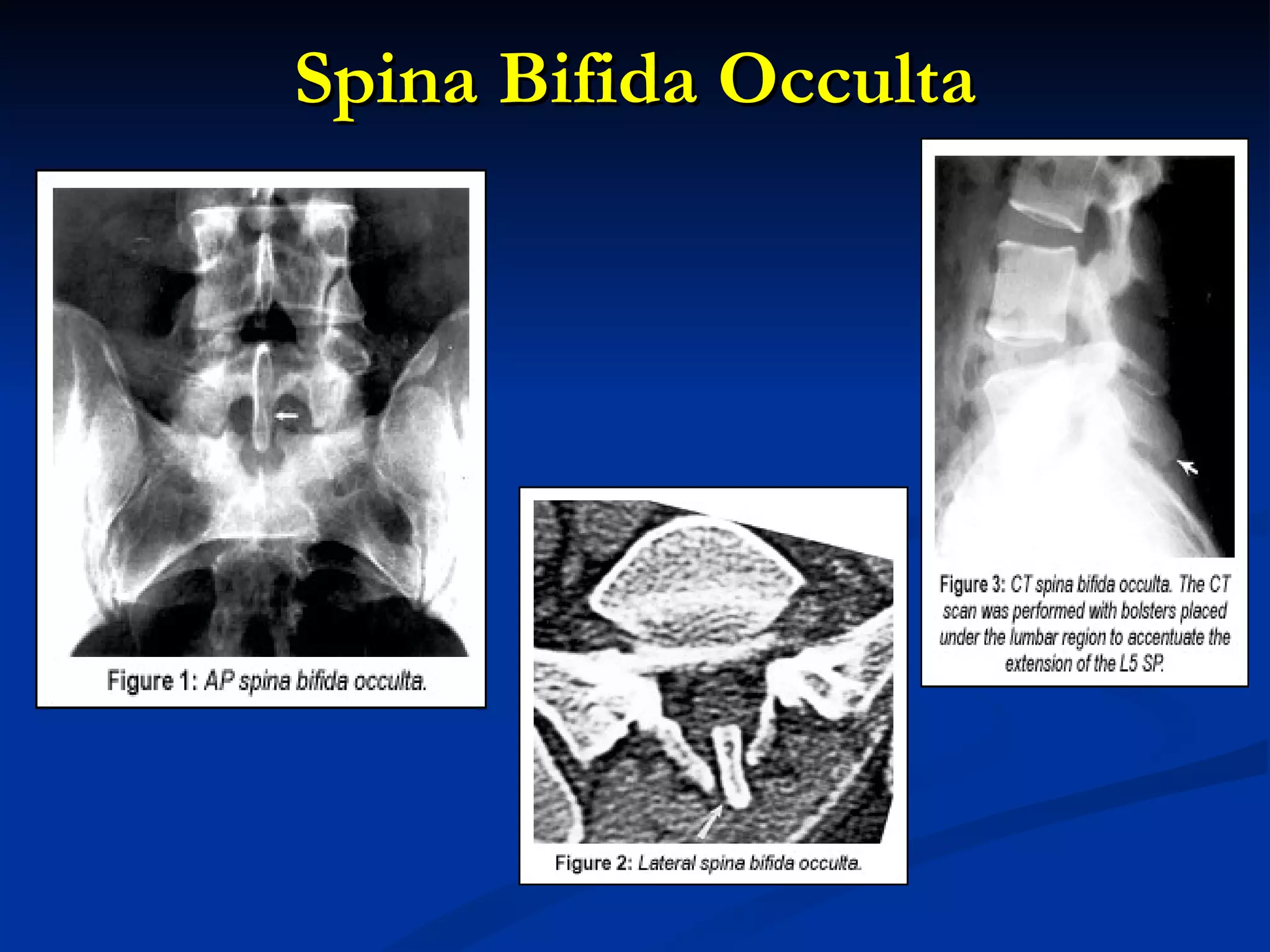 Spina Bifida Occulta 