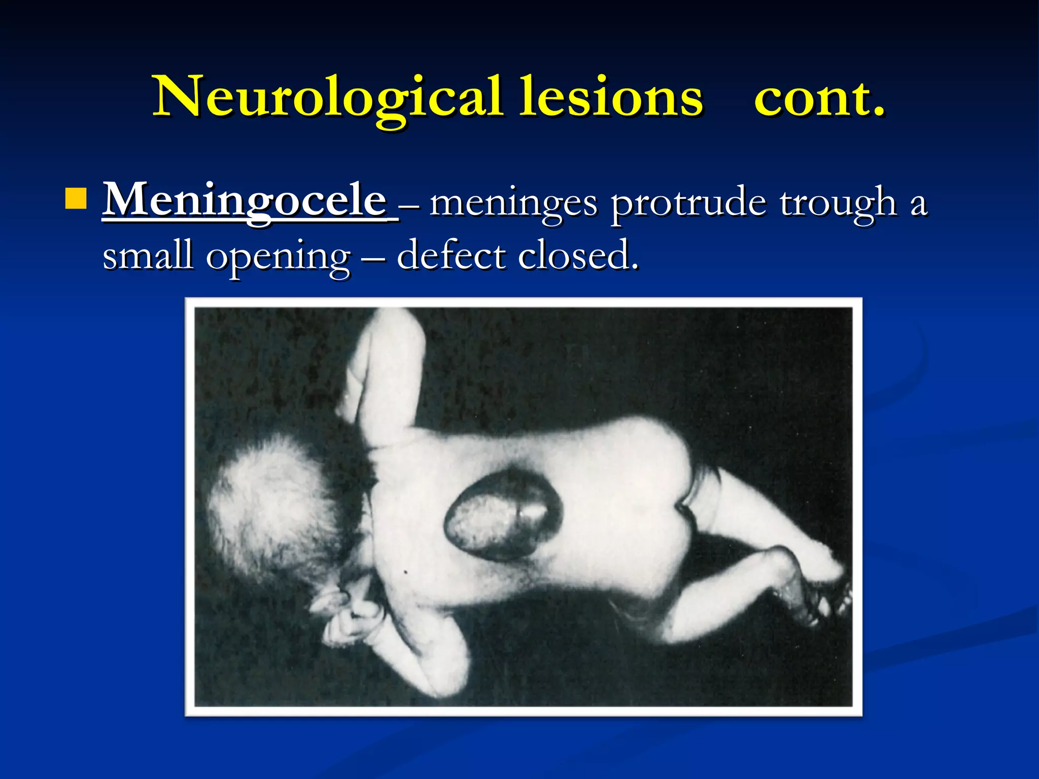 Neurological lesions  cont. Meningocele   –  meninges protrude trough a small opening – defect closed. 
