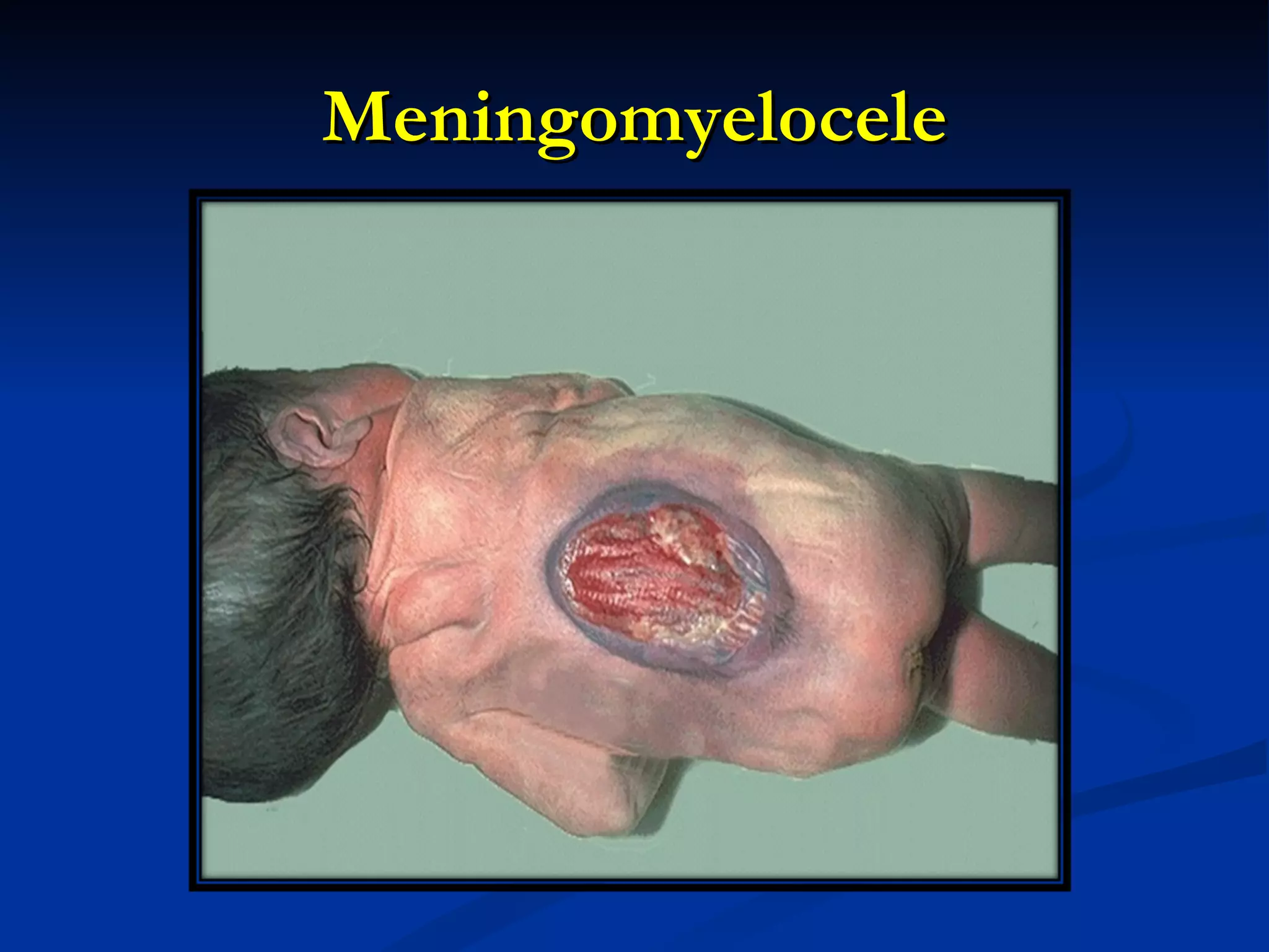Meningomyelocele 