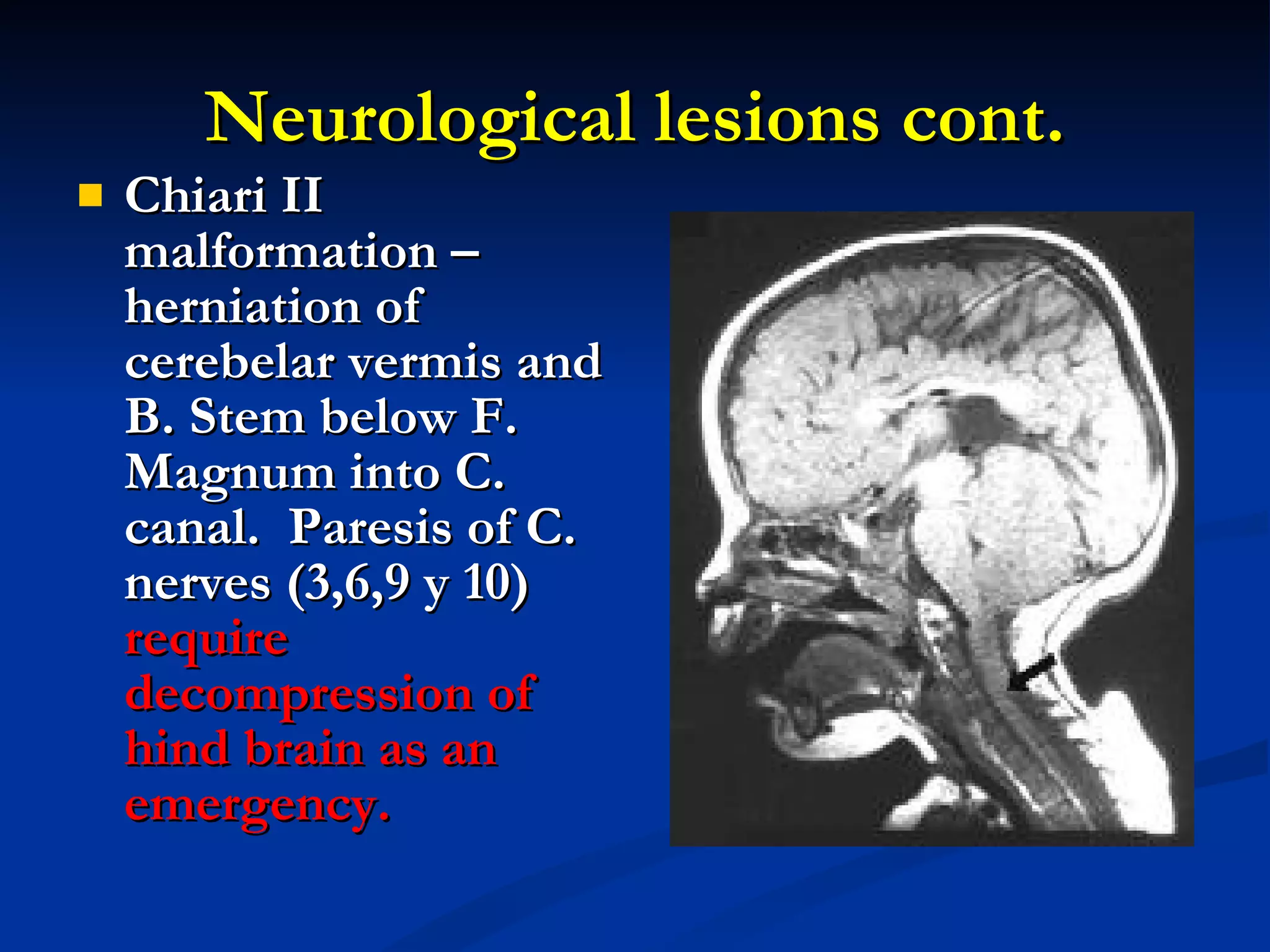 Neurological lesions cont. Chiari II malformation – herniation of cerebelar vermis and B. Stem below F. Magnum into C. canal.  Paresis of C. nerves (3,6,9 y 10)  require decompression of hind brain as an emergency. 