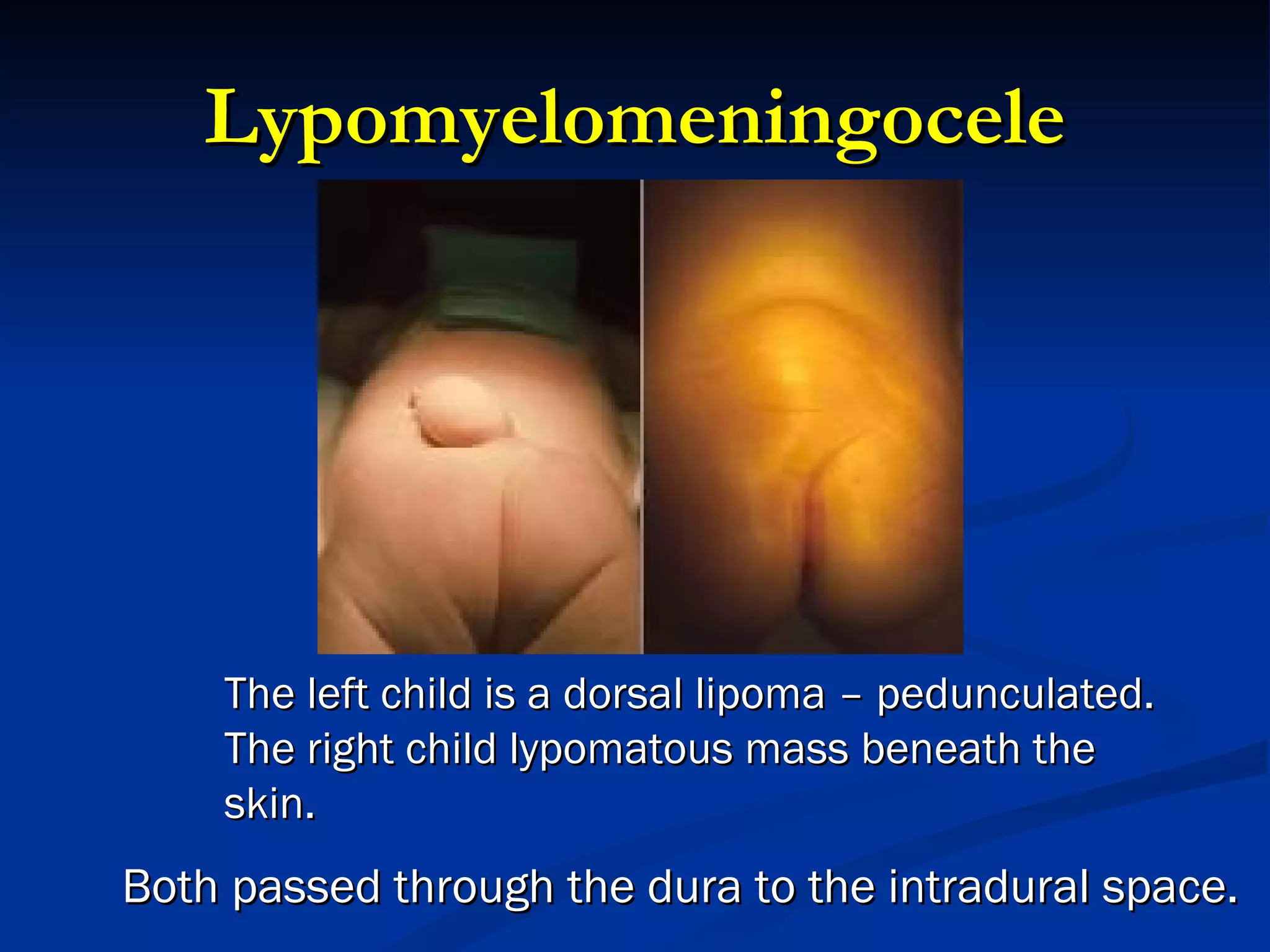 Lypomyelomeningocele The left child is a dorsal lipoma – pedunculated. The right child lypomatous mass beneath the skin. Both passed through the dura to the intradural space. 