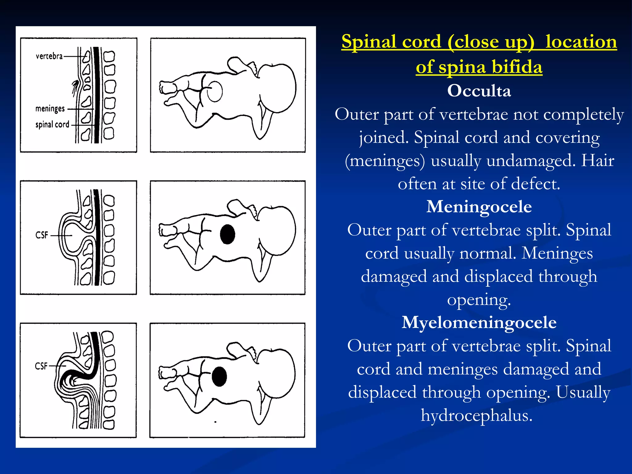                                                     Spinal cord (close up)  location of spina bifida Occulta Outer part of vertebrae not completely joined. Spinal cord and covering (meninges) usually undamaged. Hair often at site of defect. Meningocele Outer part of vertebrae split. Spinal cord usually normal. Meninges damaged and displaced through opening. Myelomeningocele Outer part of vertebrae split. Spinal cord and meninges damaged and displaced through opening. Usually hydrocephalus.  