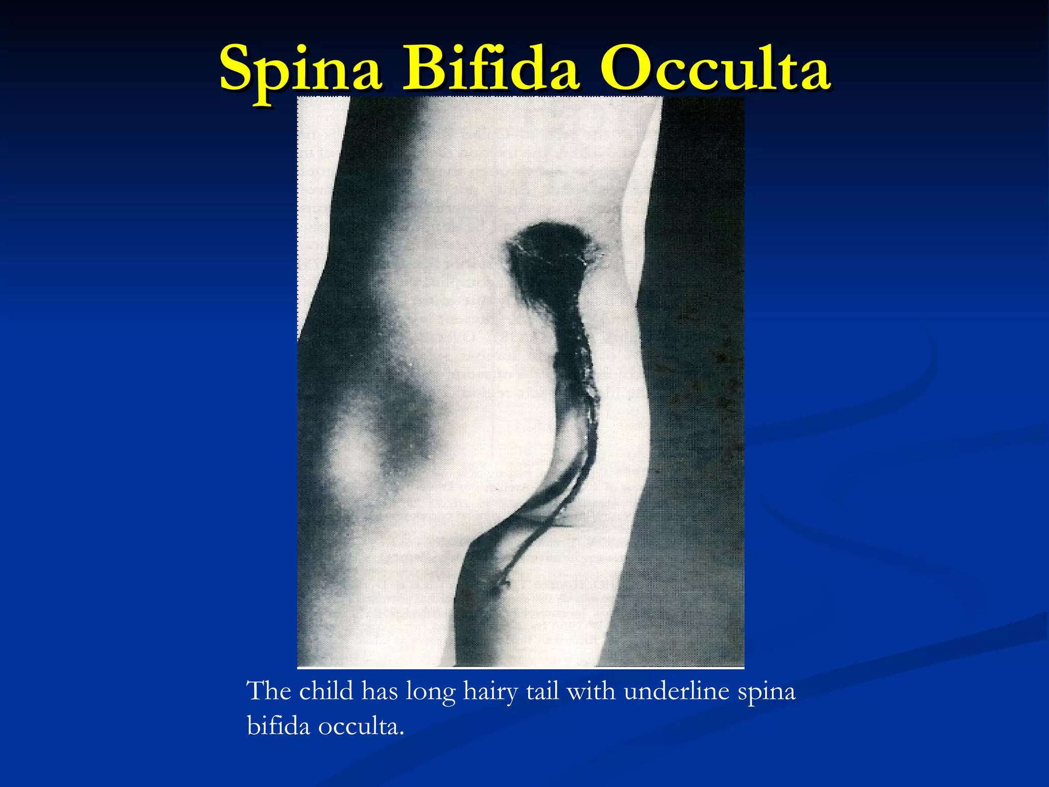 Spina Bifida Occulta The child has long hairy tail with underline spina bifida occulta. 