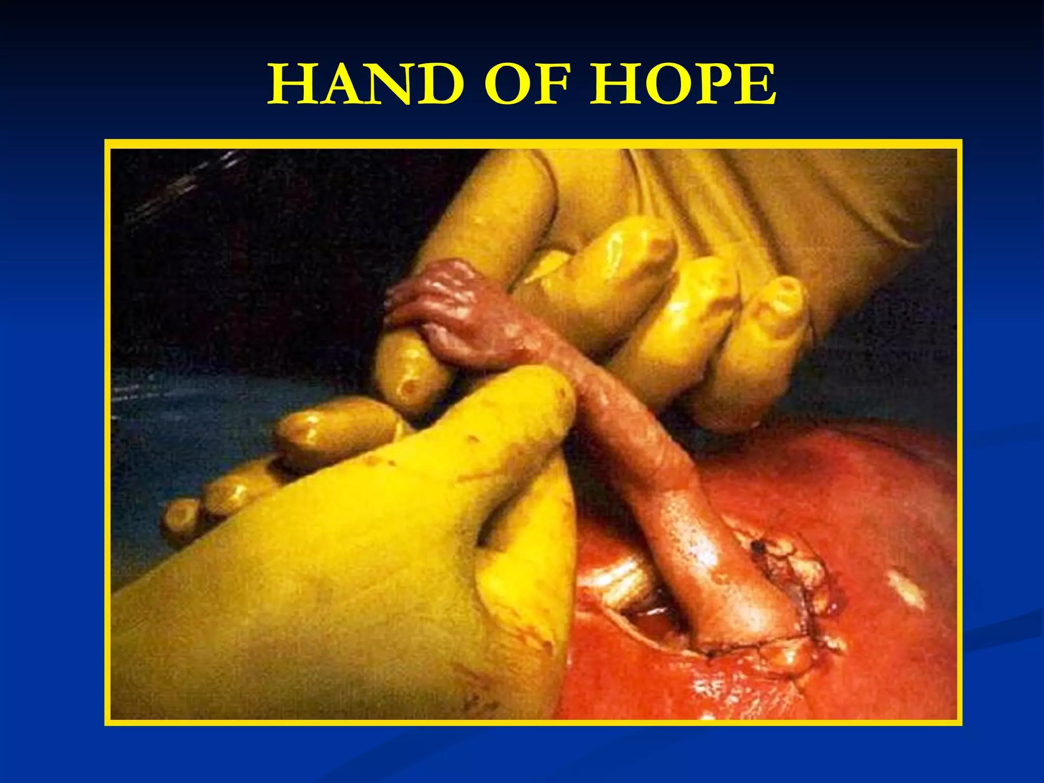 HAND OF HOPE 