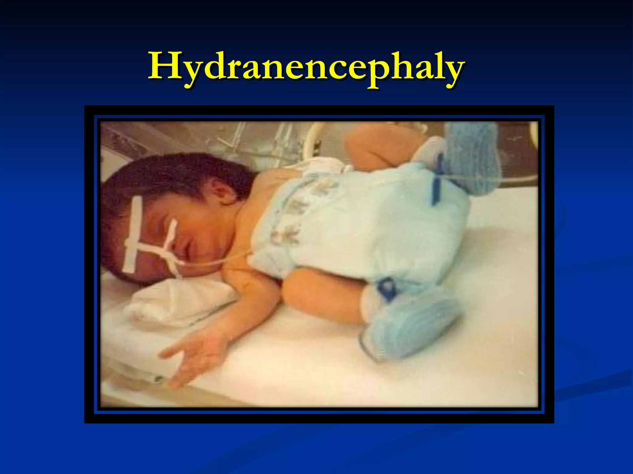 Hydranencephaly 