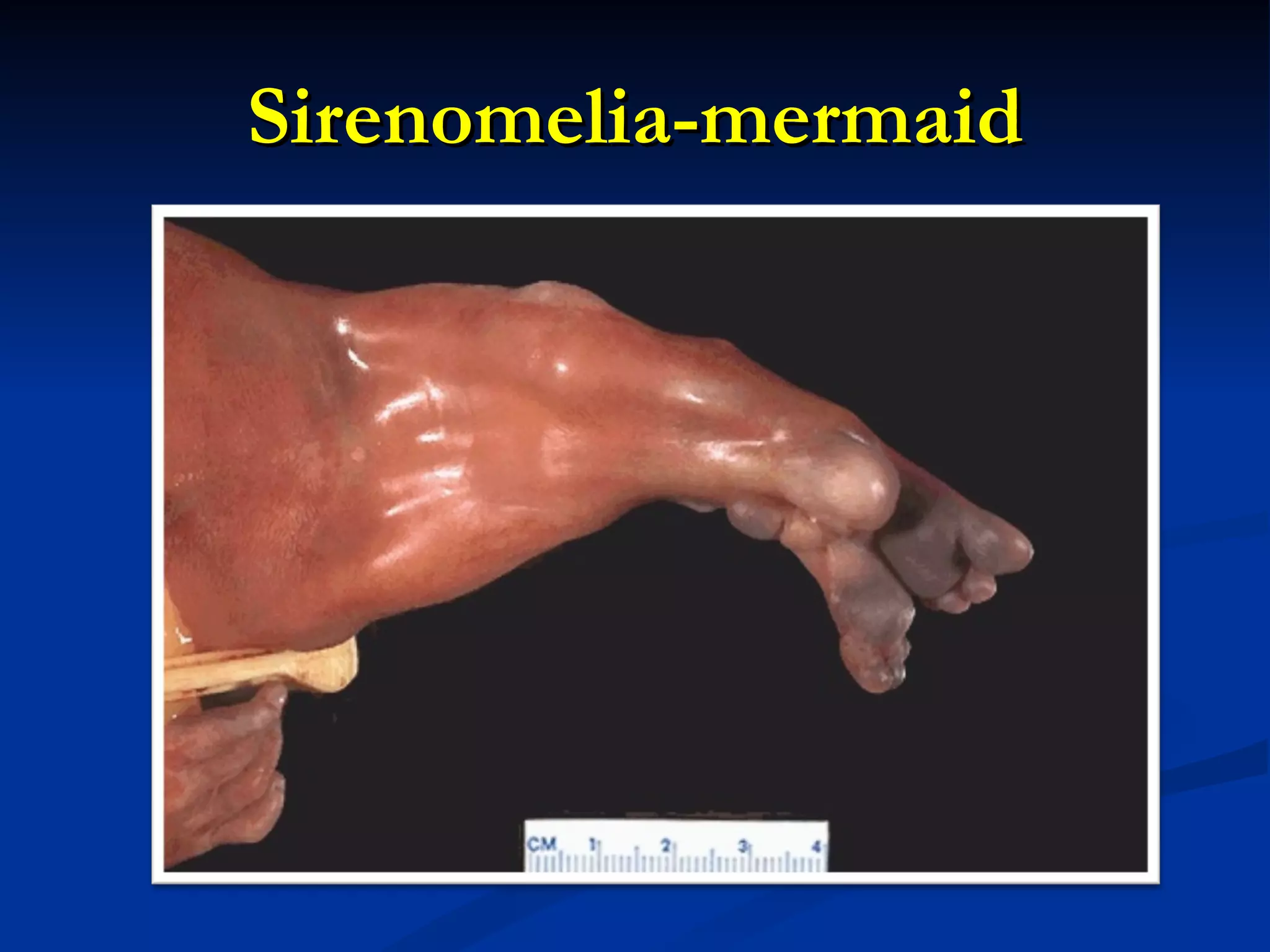 Sirenomelia-mermaid 