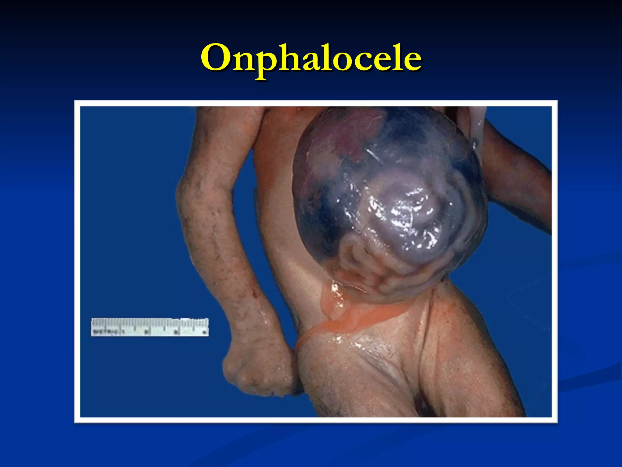 Onphalocele 