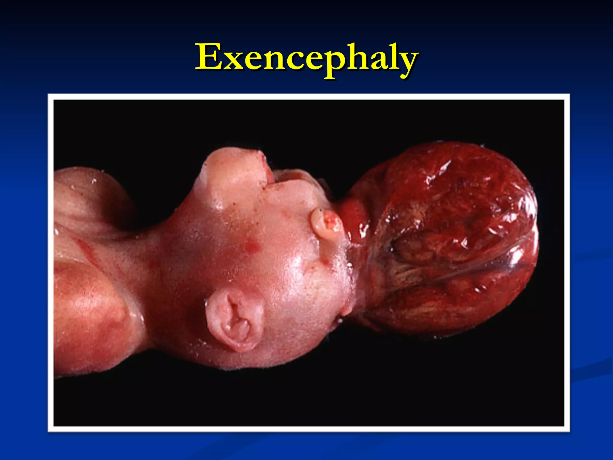 Exencephaly 