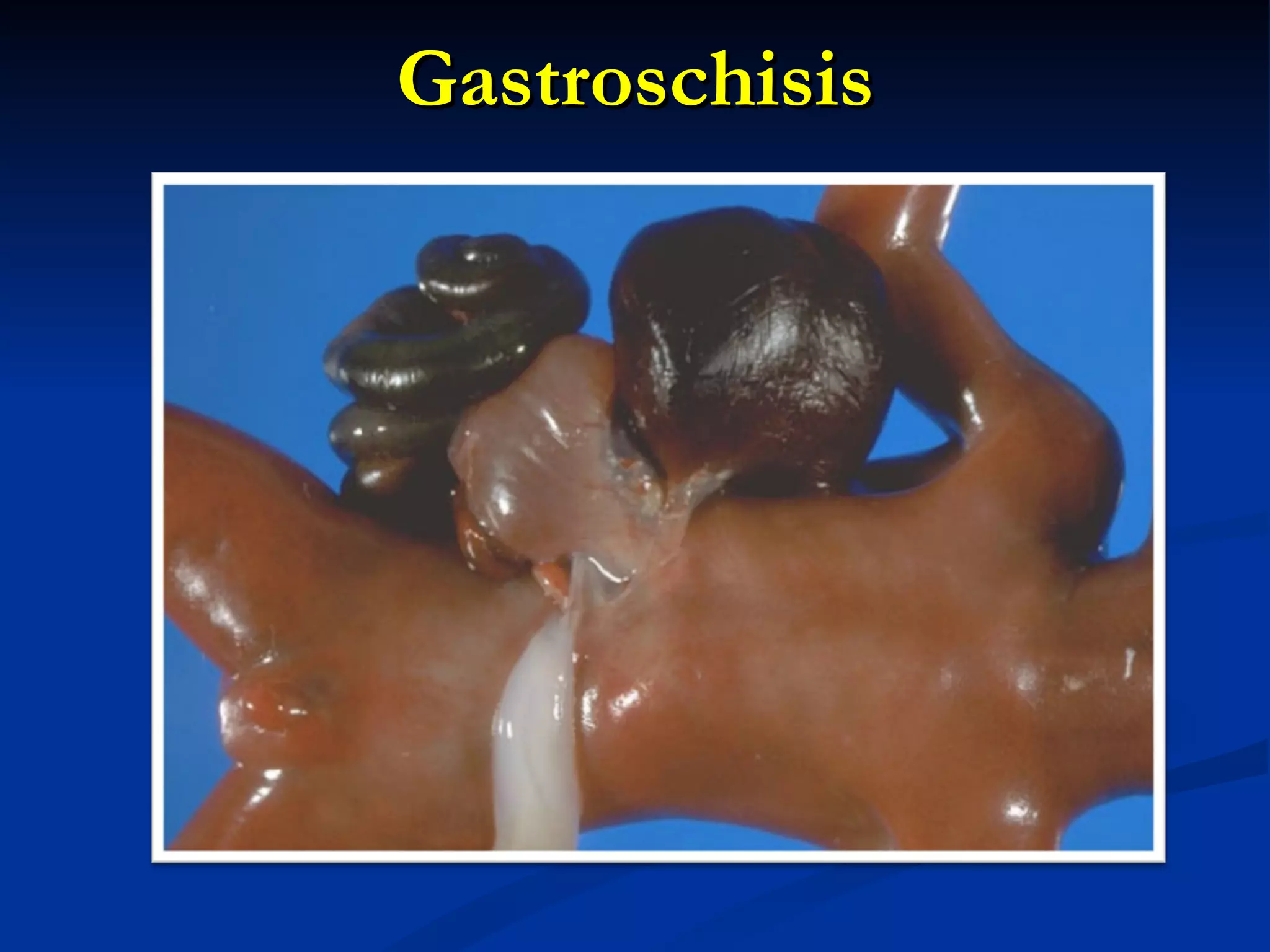 Gastroschisis 
