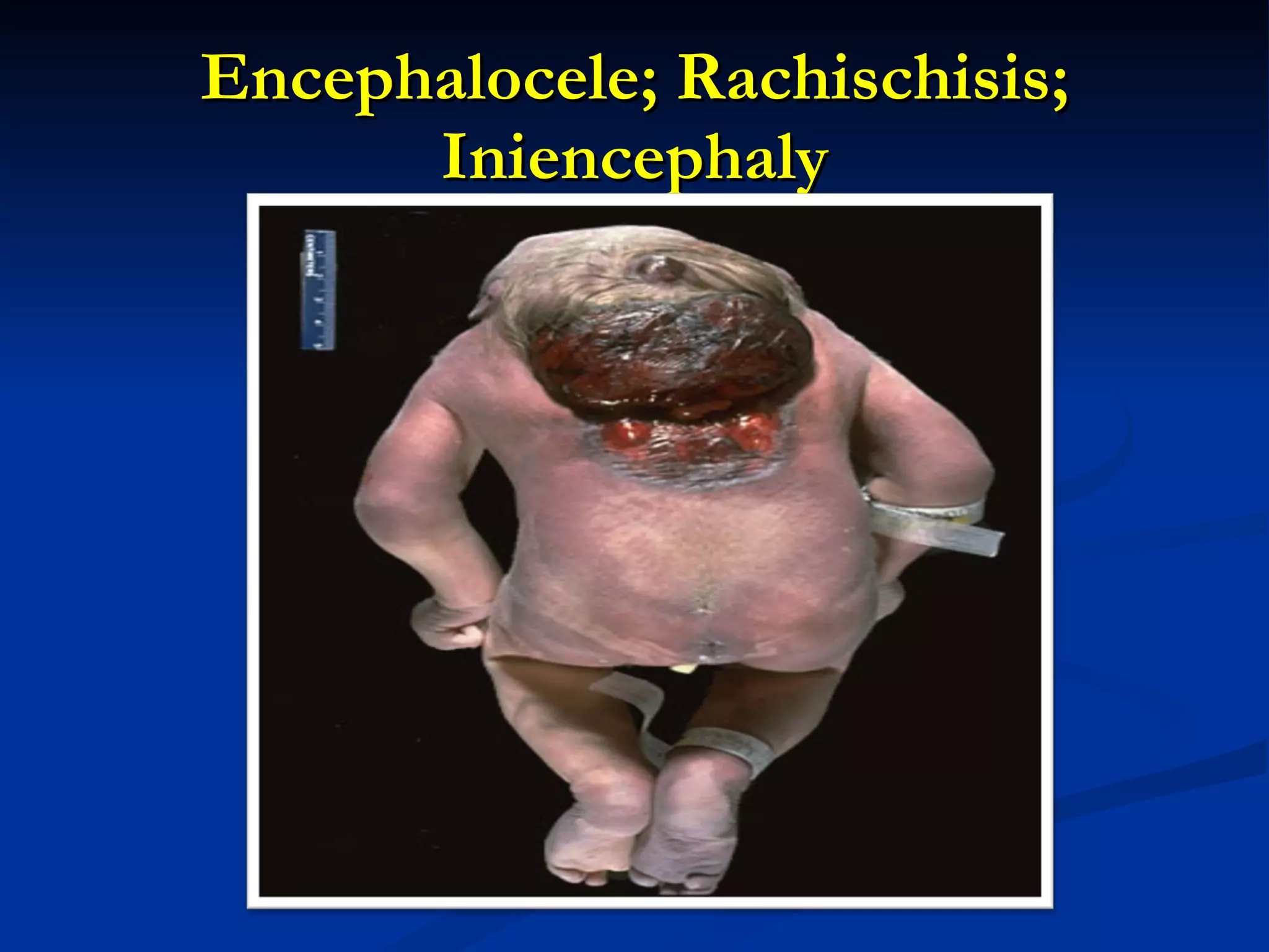 Encephalocele; Rachischisis; Iniencephaly 