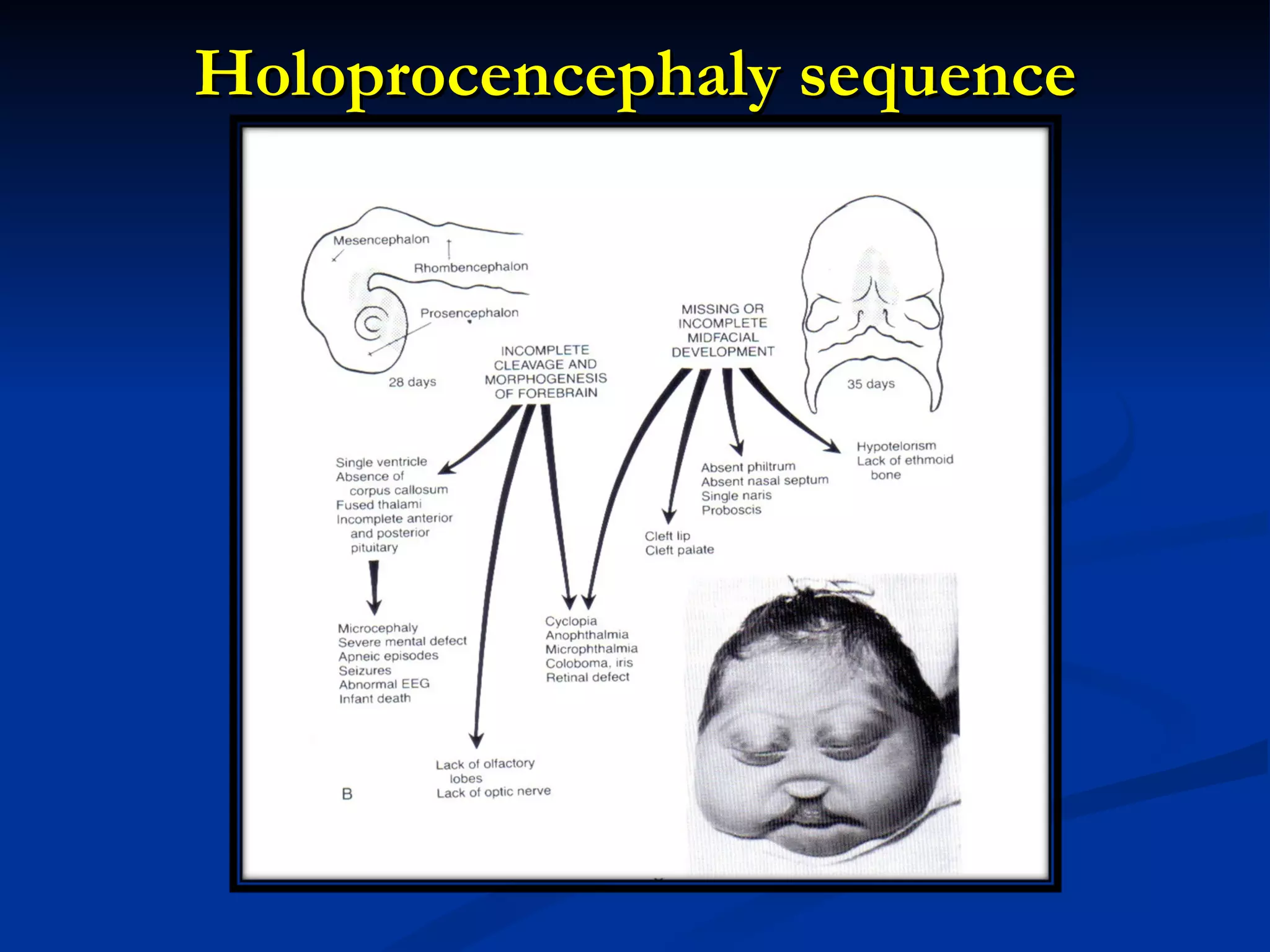Holoprocencephaly sequence 