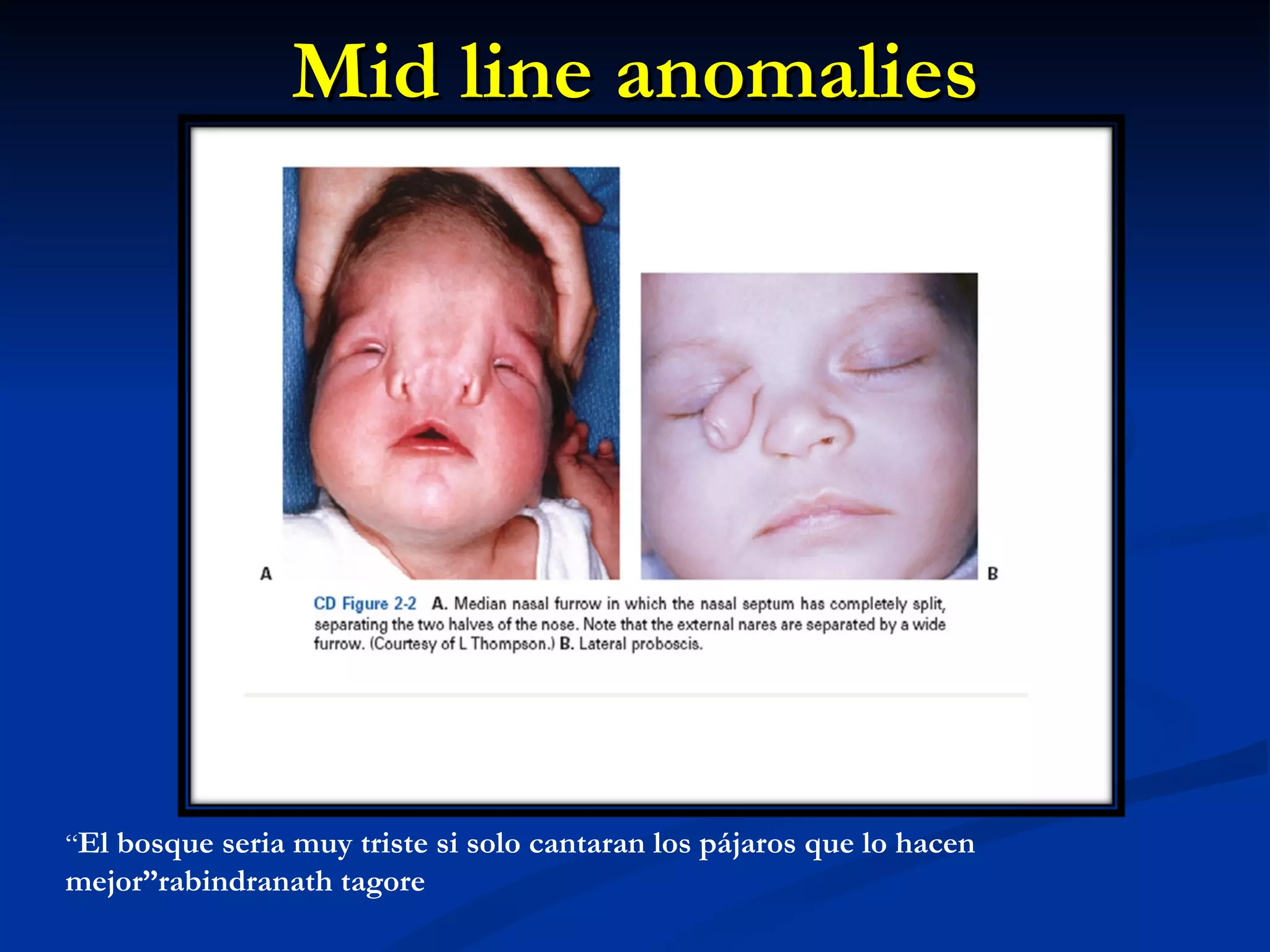 Mid line anomalies “ El bosque seria muy triste si solo cantaran los pájaros que lo hacen mejor”rabindranath tagore 