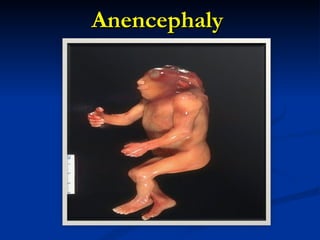Anencephaly 