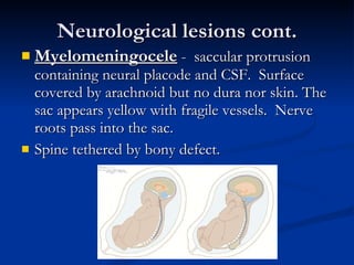 Neurological lesions cont. Myelomeningocele  -  saccular protrusion containing neural placode and CSF.  Surface covered by arachnoid but no dura nor skin. The sac appears yellow with fragile vessels.  Nerve roots pass into the sac. Spine tethered by bony defect. 