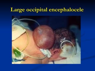 Large occipital encephalocele 