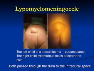 Lypomyelomeningocele The left child is a dorsal lipoma – pedunculated. The right child lypomatous mass beneath the skin. Both passed through the dura to the intradural space. 
