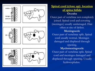                                                     Spinal cord (close up)  location of spina bifida Occulta Outer part of vertebrae not completely joined. Spinal cord and covering (meninges) usually undamaged. Hair often at site of defect. Meningocele Outer part of vertebrae split. Spinal cord usually normal. Meninges damaged and displaced through opening. Myelomeningocele Outer part of vertebrae split. Spinal cord and meninges damaged and displaced through opening. Usually hydrocephalus.  