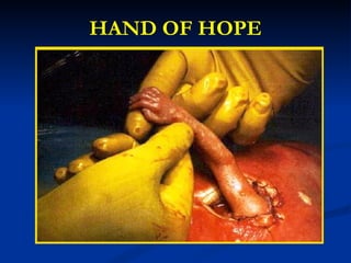HAND OF HOPE 
