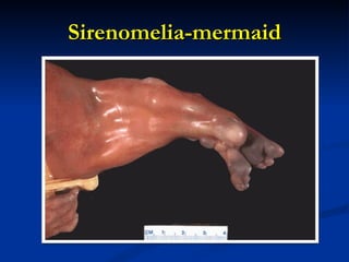 Sirenomelia-mermaid 