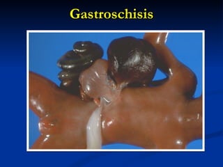 Gastroschisis 