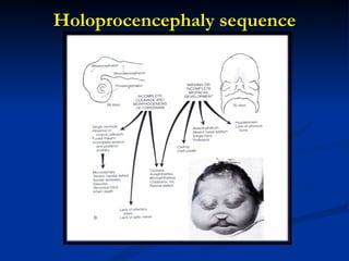 Holoprocencephaly sequence 