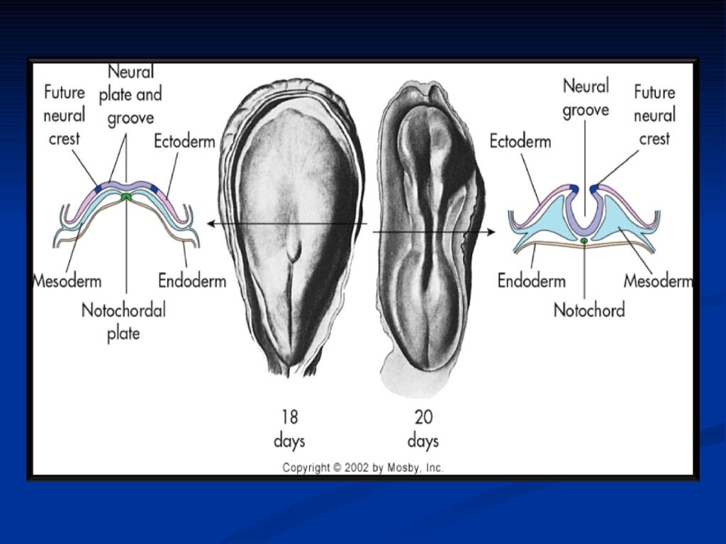 Neural tube defects