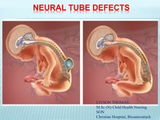 NEURAL TUBE DEFECTS
LIVSON THOMAS
M.Sc (N) Child Health Nursing
SON
Christian Hospital, Bissamcuttack
 