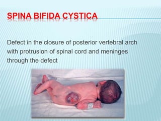 SPINA BIFIDA CYSTICA
Defect in the closure of posterior vertebral arch
with protrusion of spinal cord and meninges
through the defect
 