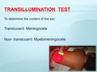 TRANSILLUMINATION TEST
To determine the content of the sac:
Translucent: Meningocele
Non- translucent: Myelomeningocele
 