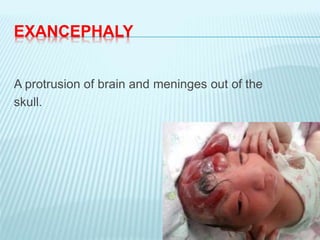 EXANCEPHALY
A protrusion of brain and meninges out of the
skull.
 