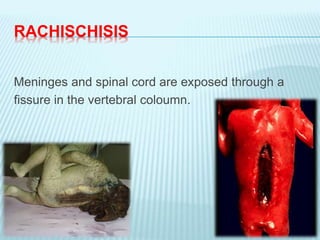 RACHISCHISIS
Meninges and spinal cord are exposed through a
fissure in the vertebral coloumn.
 