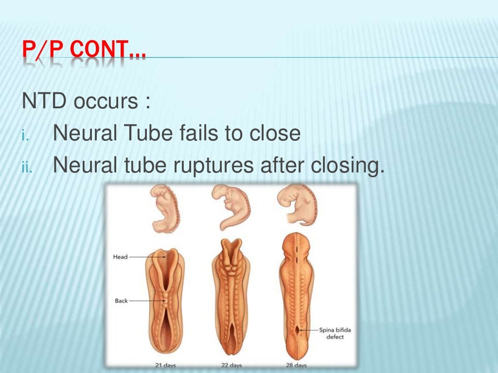 Neural tube defects